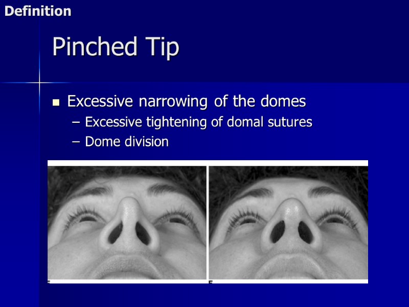 Pinched Tip Excessive narrowing of the domes Excessive tightening of domal sutures Dome division